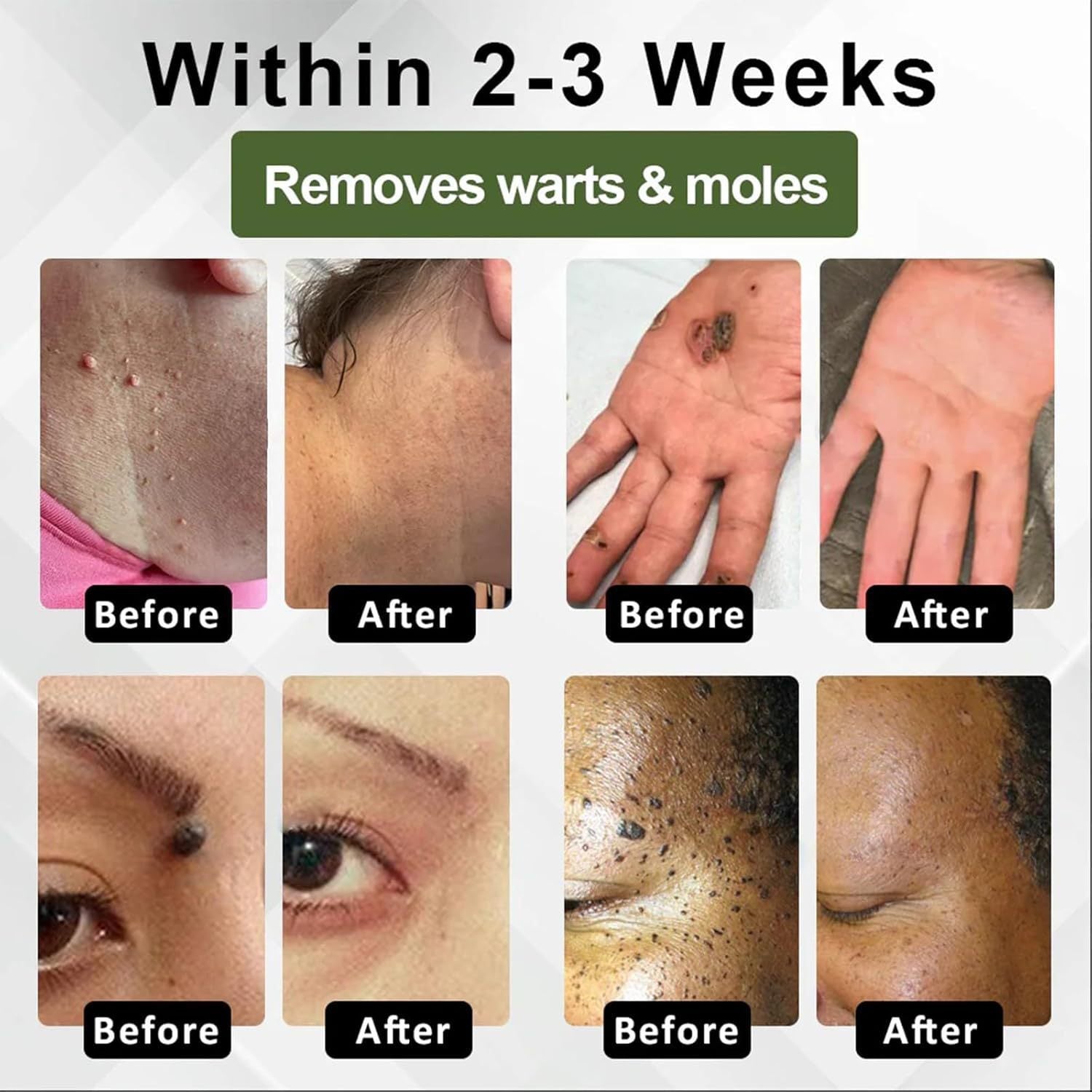 Mole Spot Removal Gel