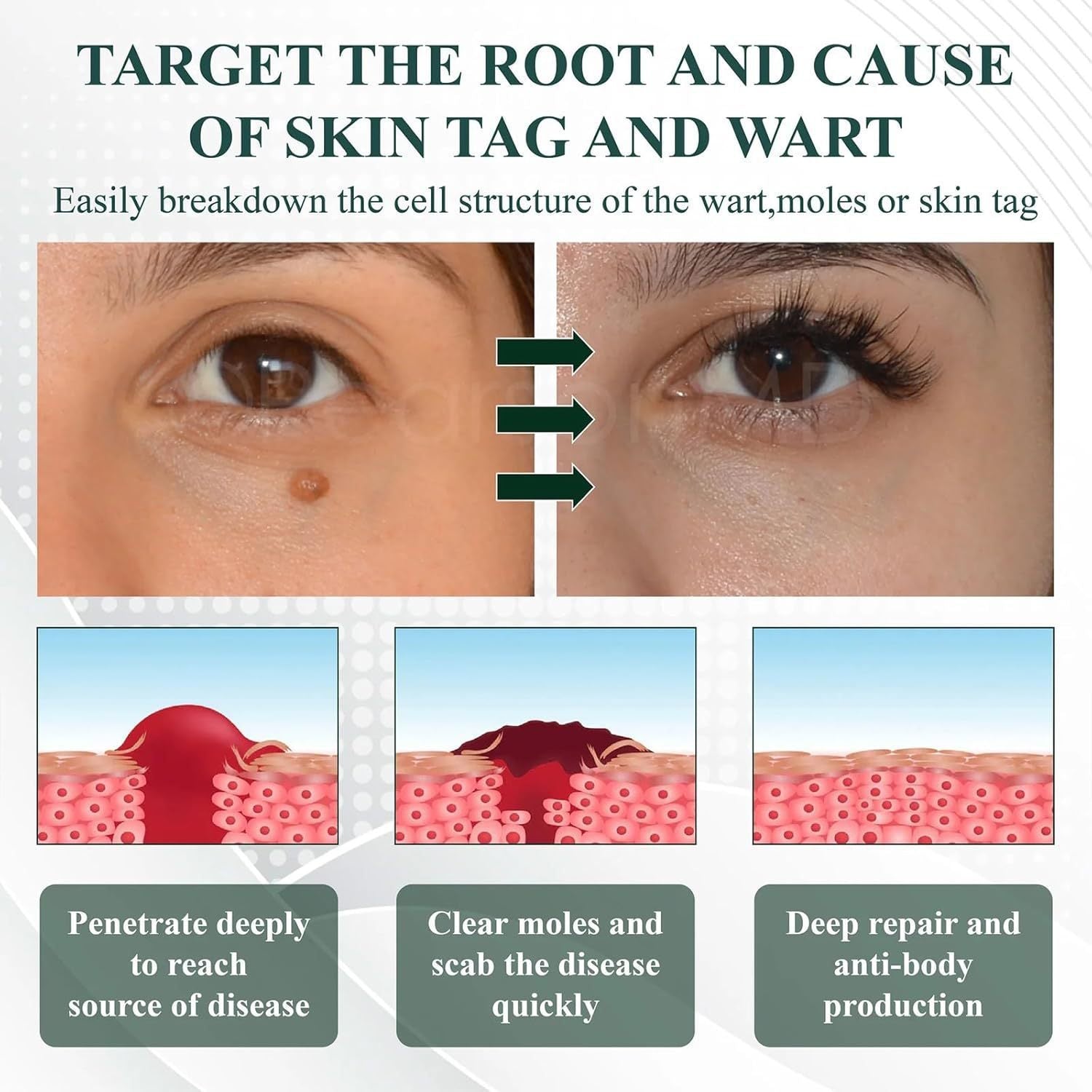 Mole Spot Removal Gel